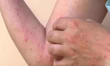 ¡Alarma en Lima! Más de 30 casos de la ‘viruela del mono’ registrados