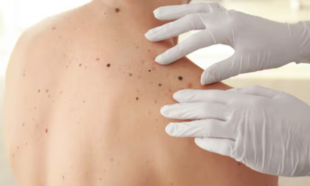 ¡Protege tu piel! 29 casos de melanoma maligno en La Libertad encienden las alarmas.